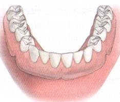 Dentures affixed to dental implants