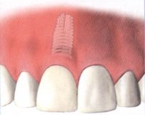 How dental implants work